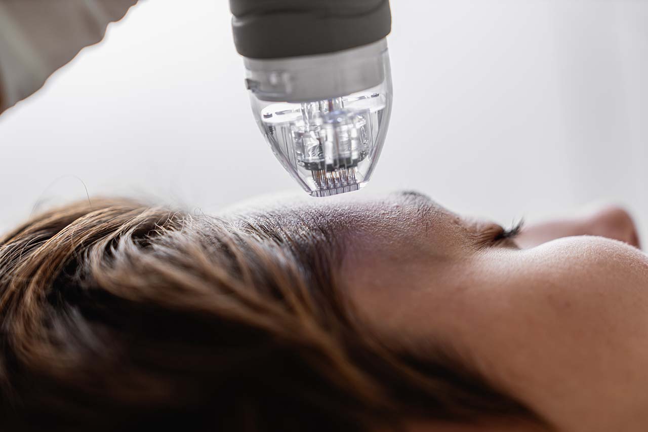 closeup of microneedle device on woman's face Microneedling treatment targeting skin rejuvenation, performed by Body Soul Nutrition Regenerative Institute.