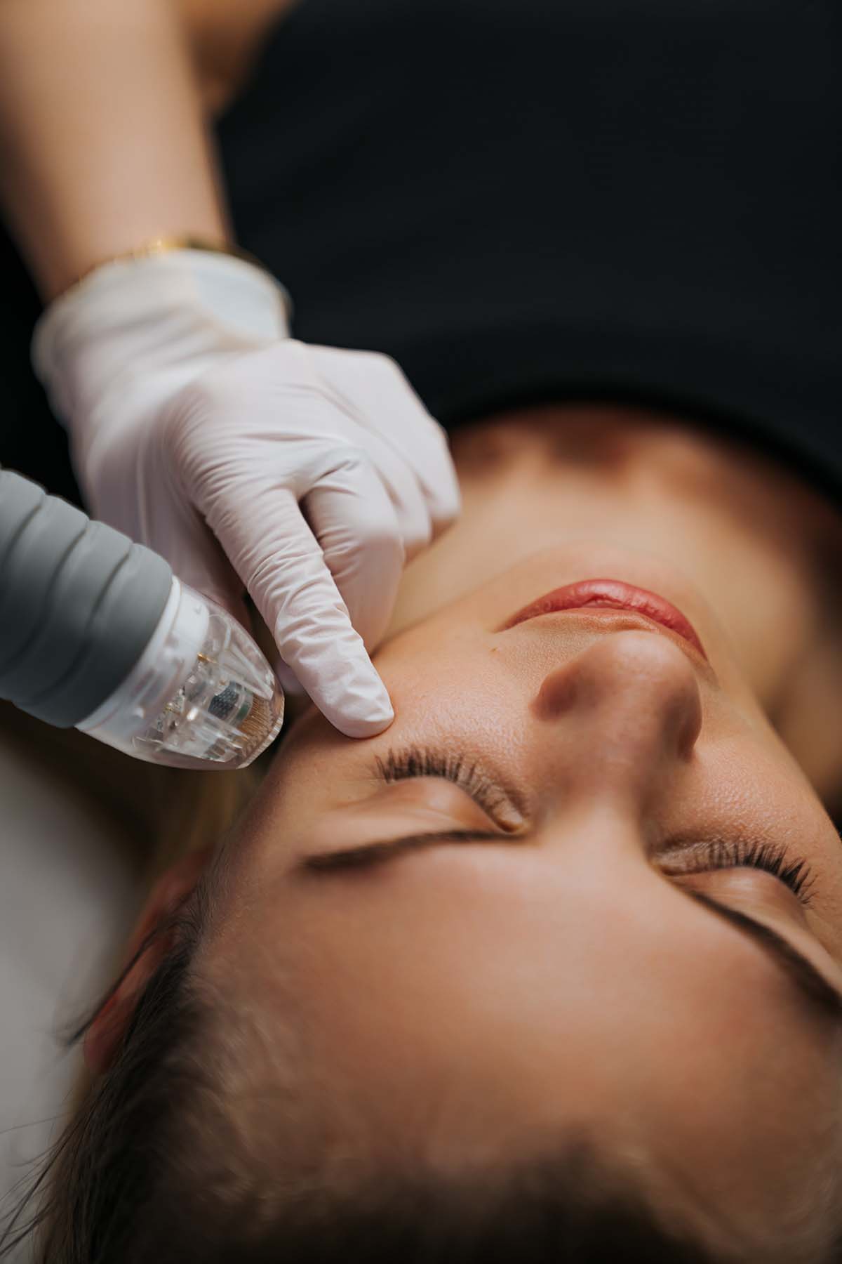 woman relaxes during her microneedle lifting procedure Relaxed patient undergoing microneedle lifting procedure for skin rejuvenation in Sherman Oaks.