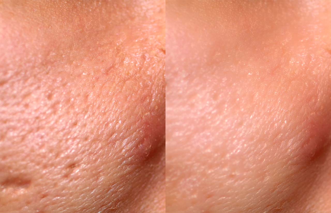Comparison of skin before and after laser resurfacing Before and after laser resurfacing showing improved skin texture and tone.