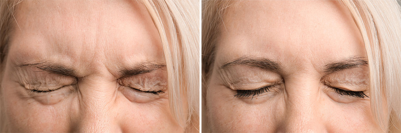 woman's forehead wrinkles before and after treatment Visible improvement in forehead lines with Botox & Fillers at Body Soul Nutrition.